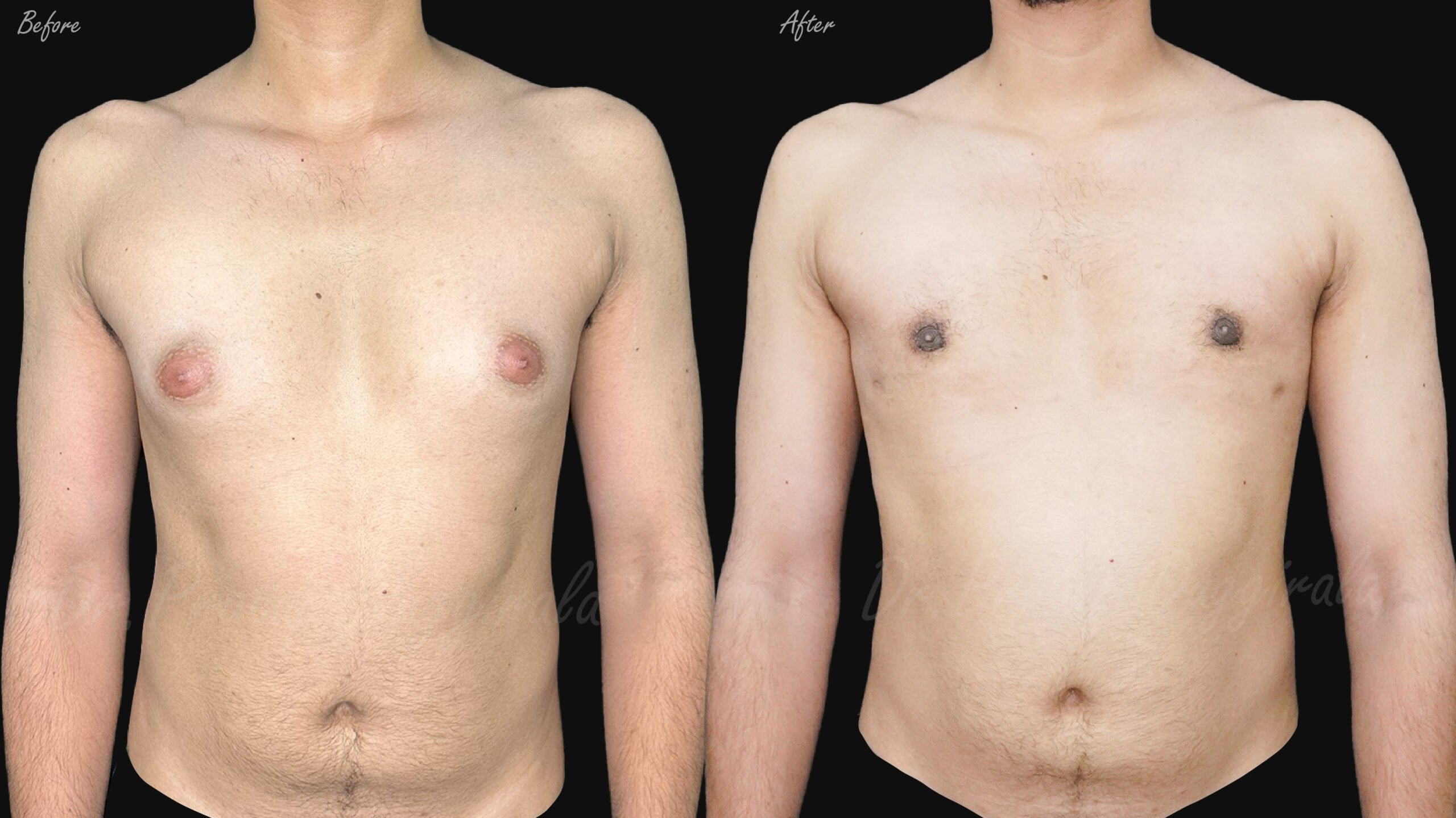 Gynaecomastia-grade 1