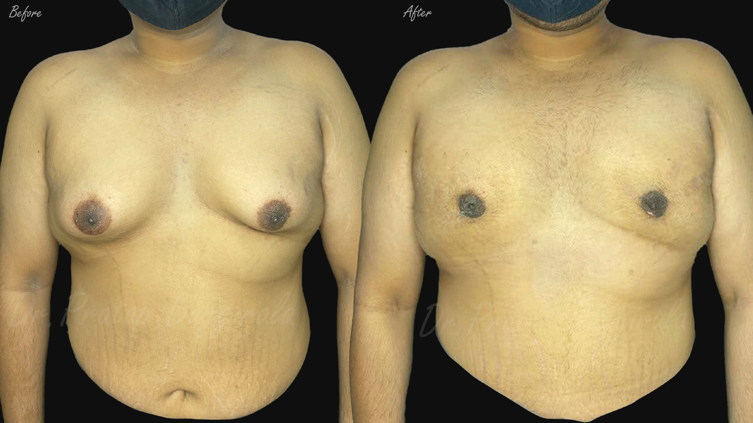 Gynaecomastia grade 3-