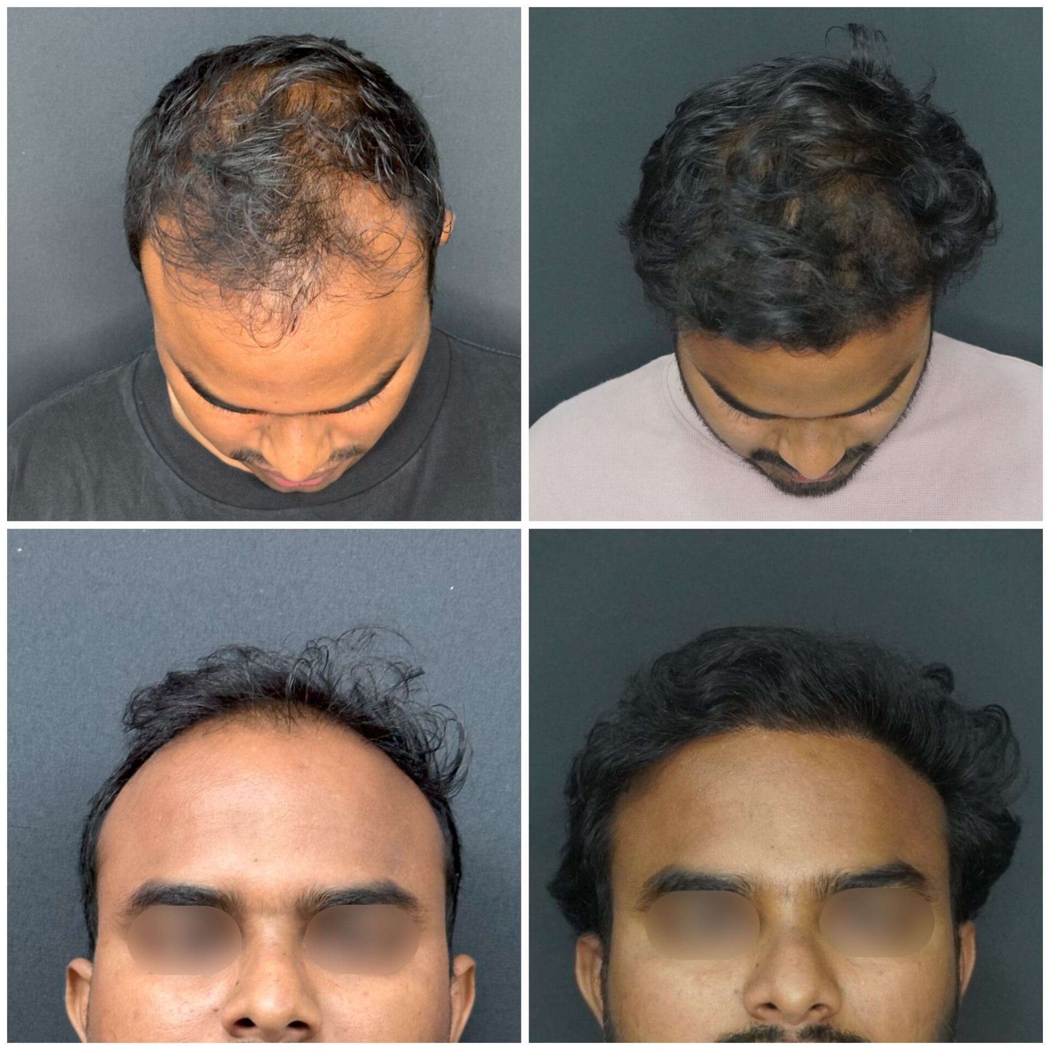 hair transplant 1