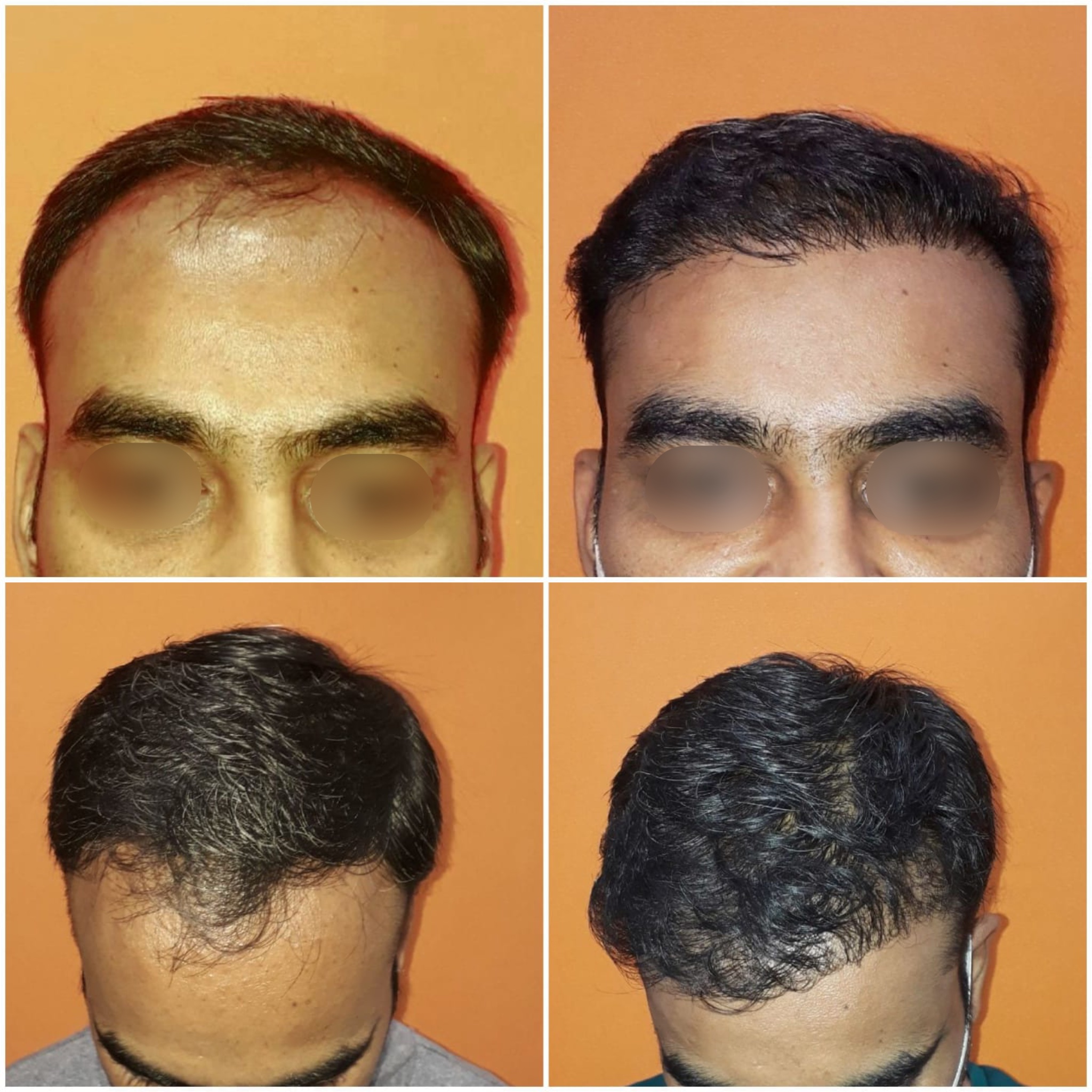hair transplant 2