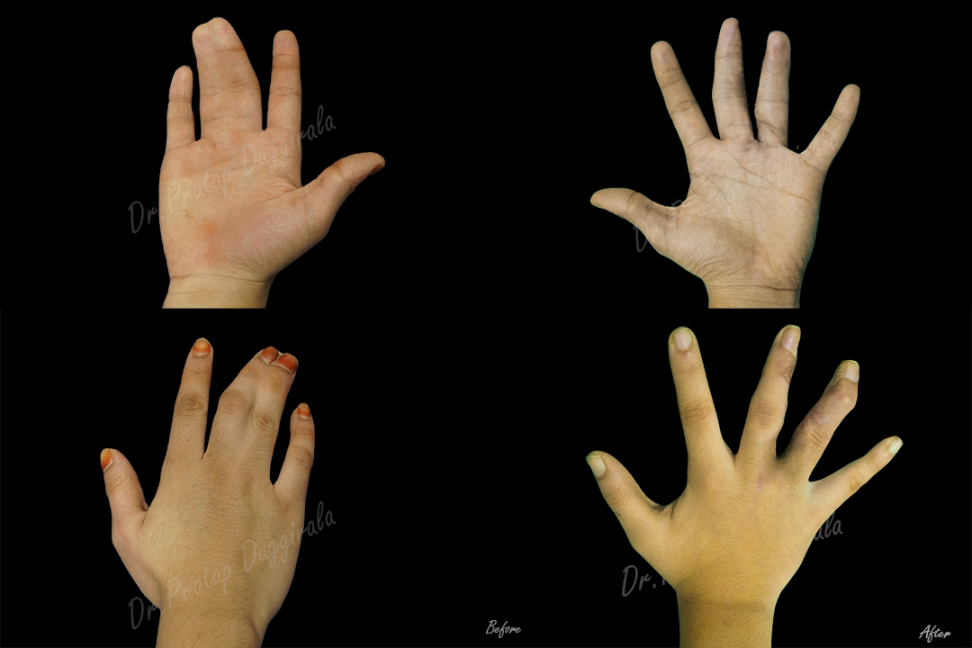 syndactyly 2
