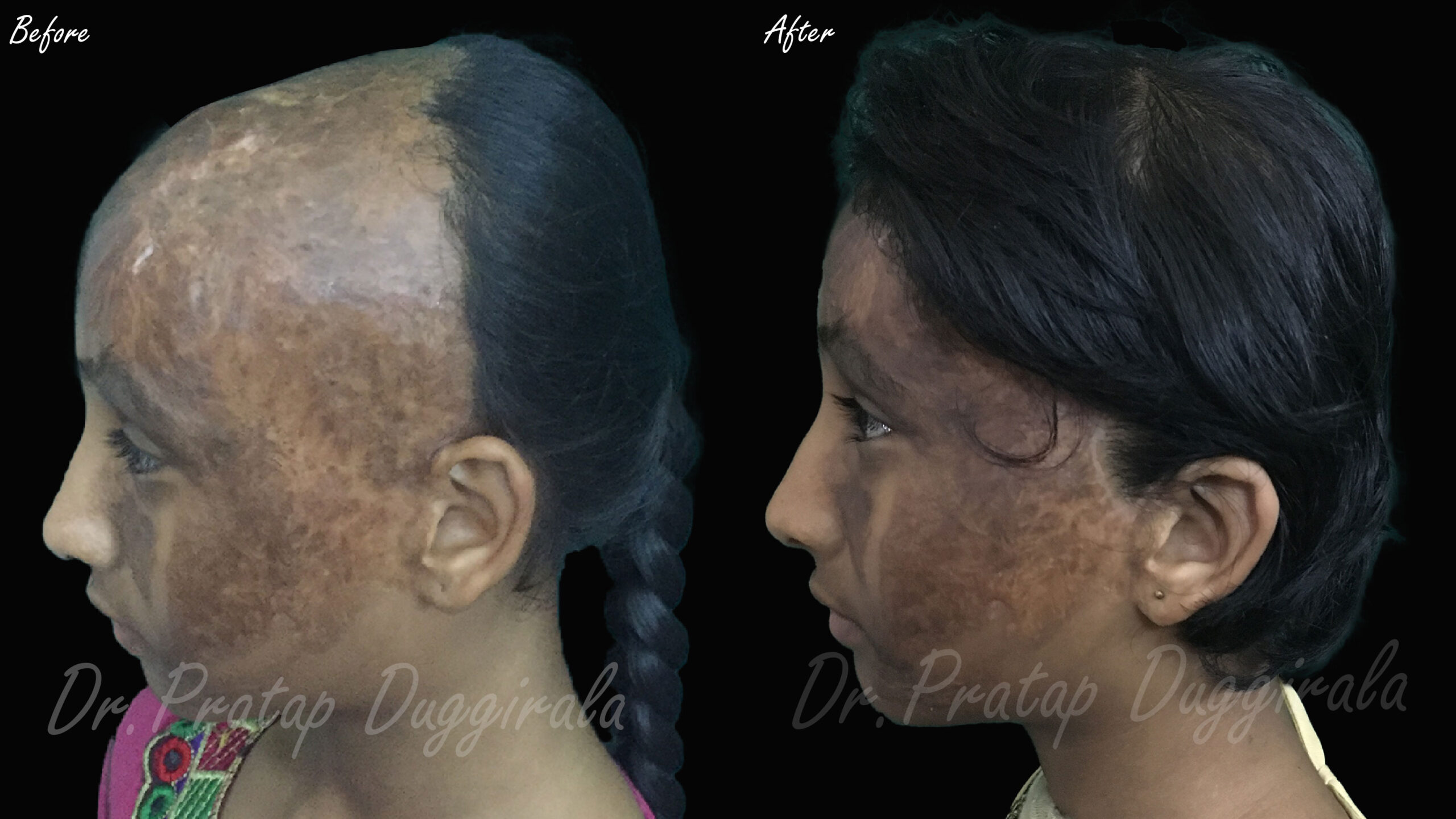 tissue-expander-side